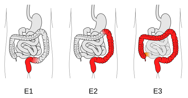 Therapie bei Colitis ulcerosa